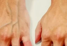 Veias saltadas são motivos para se preocupar? Médica esclarece