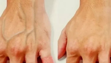 Veias saltadas são motivos para se preocupar? Médica esclarece