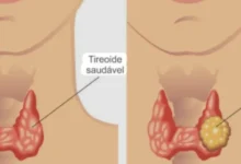 9 sinais de câncer de tireoide que não devem ser ignorados em hipótese alguma