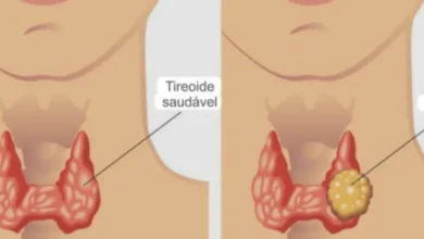 9 sinais de câncer de tireoide que não devem ser ignorados em hipótese alguma