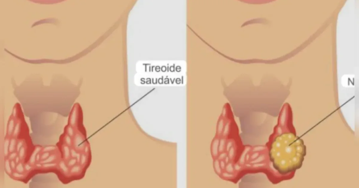 9 sinais de câncer de tireoide que não devem ser ignorados em hipótese alguma