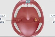 Bolinhas fedidas na garganta: descubra agora o que realmente são e por que surgem