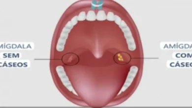Bolinhas fedidas na garganta: descubra agora o que realmente são e por que surgem