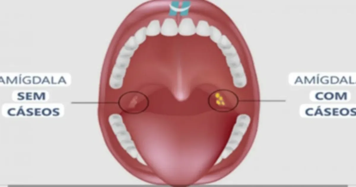 Bolinhas fedidas na garganta: descubra agora o que realmente são e por que surgem