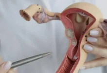 Cinco sintomas de alerta que podem indicar câncer do colo do útero