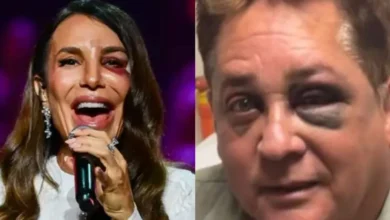 Entenda o ‘olho roxo’ de Ivete Sangalo e de Leonardo