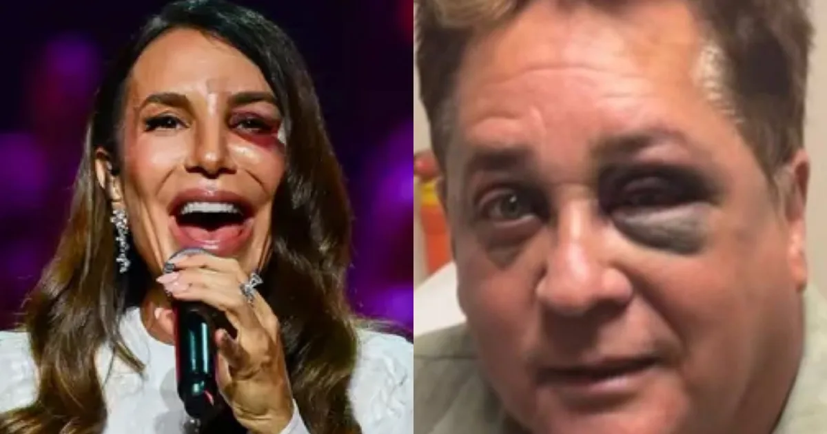 Entenda o ‘olho roxo’ de Ivete Sangalo e de Leonardo