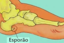 iga adeus à dor no calcanhar: 3 tratamentos naturais para esporão