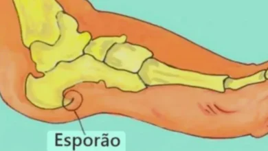 iga adeus à dor no calcanhar: 3 tratamentos naturais para esporão