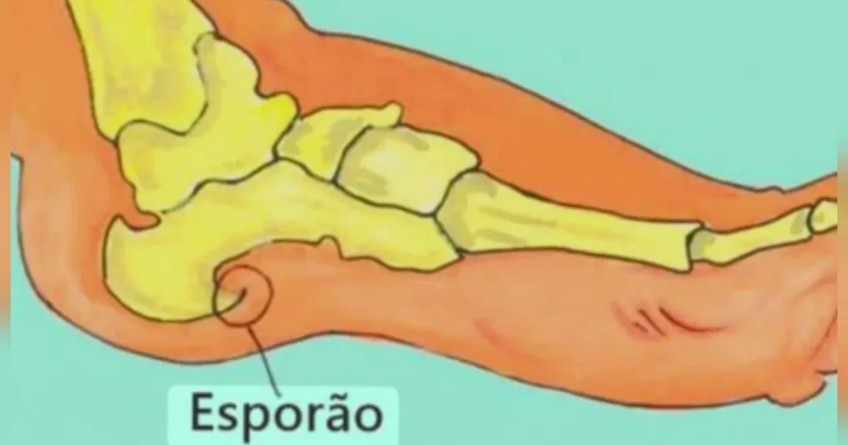 iga adeus à dor no calcanhar: 3 tratamentos naturais para esporão