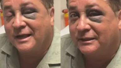 Susto nos Fãs: Leonardo aparece com hematoma no rosto e explica o que aconteceu