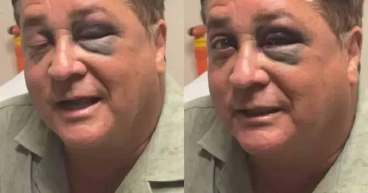 Susto nos Fãs: Leonardo aparece com hematoma no rosto e explica o que aconteceu