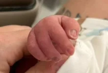 Bebê nasce com “nadadeira da sorte” e emociona