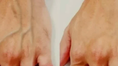 Veias saltadas podem indicar problemas de saúde?