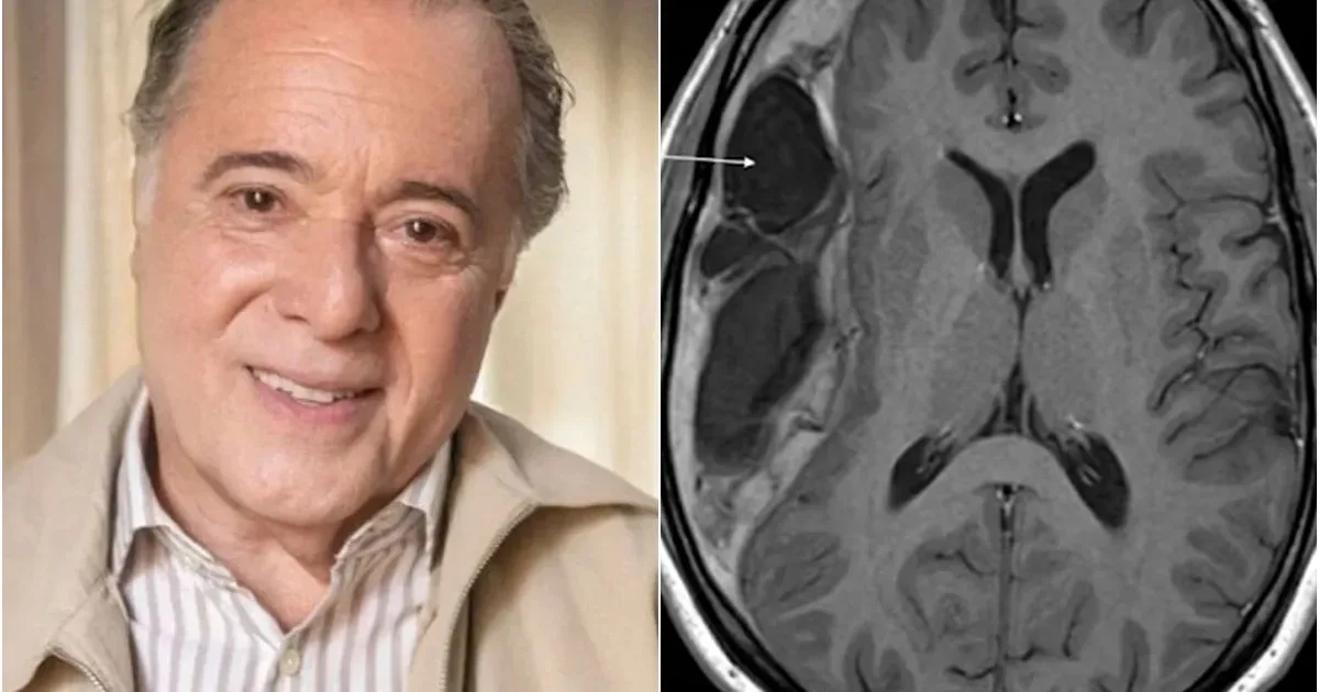 Alerta médico: Especialistas explicam a condição de saúde diagnosticada recentemente no ator Tony Ramos