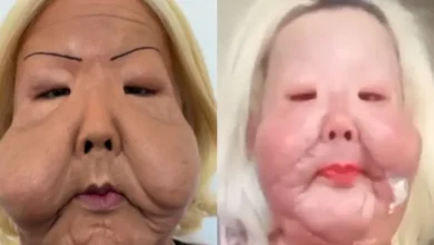 Juju do Pix mostra transformação após seis meses de reconstrução facial