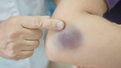 Manchas escuras inesperadas podem esconder problemas de saúde