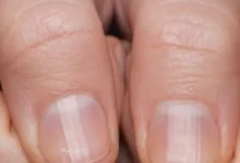 Mudanças nas unhas: o que significam as linhas nas mãos e nos pés
