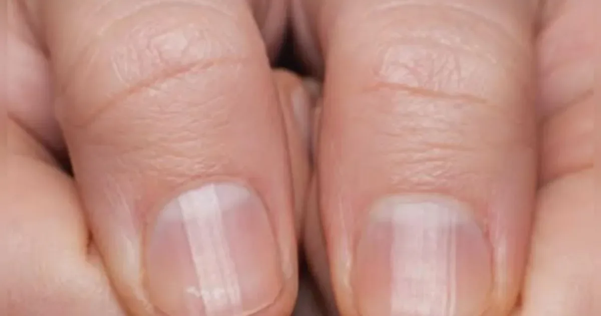 Mudanças nas unhas: o que significam as linhas nas mãos e nos pés