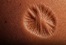 Qual é a explicação para essa vacina antiga ter deixado uma cicatriz tão diferente? Saiba mais
