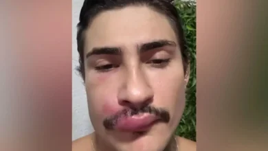 Caso de influenciador acende alerta sobre cuidados com espinhas