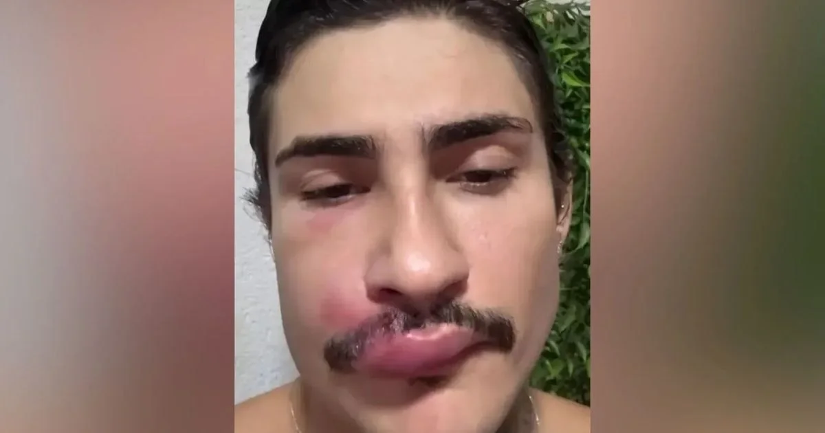 Caso de influenciador acende alerta sobre cuidados com espinhas