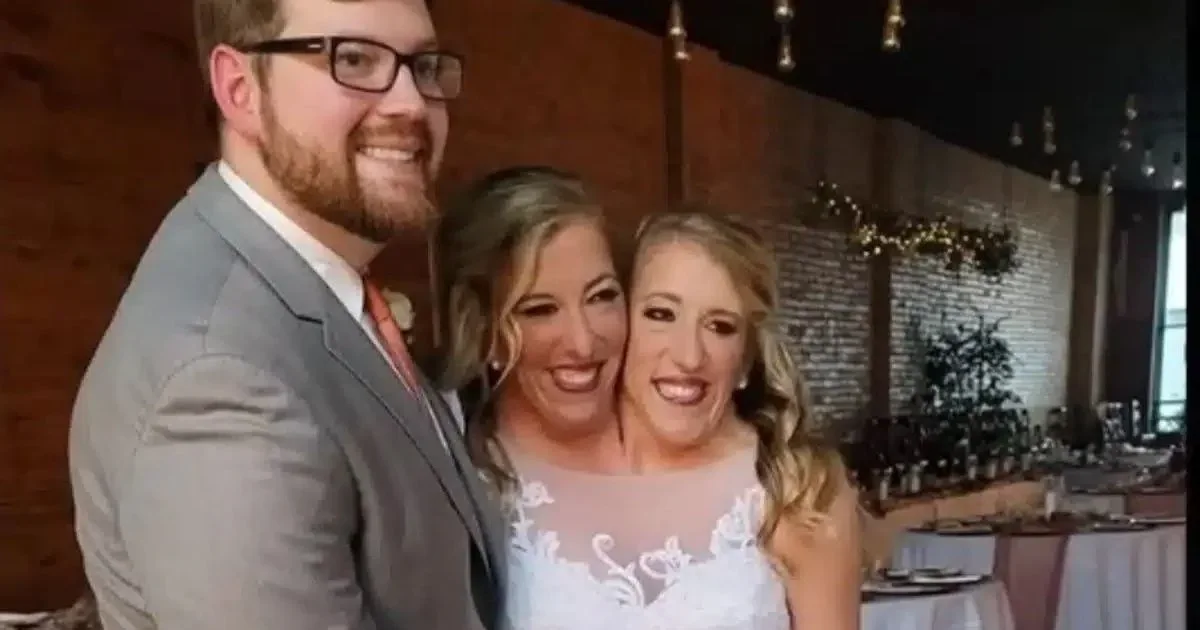 Gêmeas siamesas aparecem com bebê e declaração do marido chama atenção