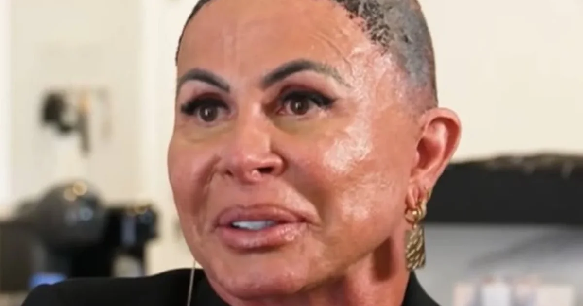 Gretchen fala sobre alopecia e revela detalhes de seu tratamento