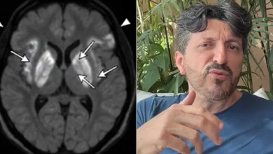 Lito Souza é diagnosticado com doença rara e sem cura que causa demência