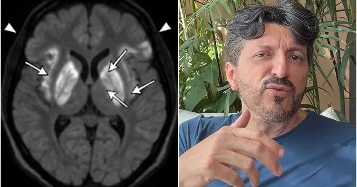 Lito Souza é diagnosticado com doença rara e sem cura que causa demência