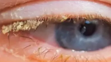 A crosta amarelada no canto dos olhos ao acordar pode ter uma explicação veja quando merece atenção