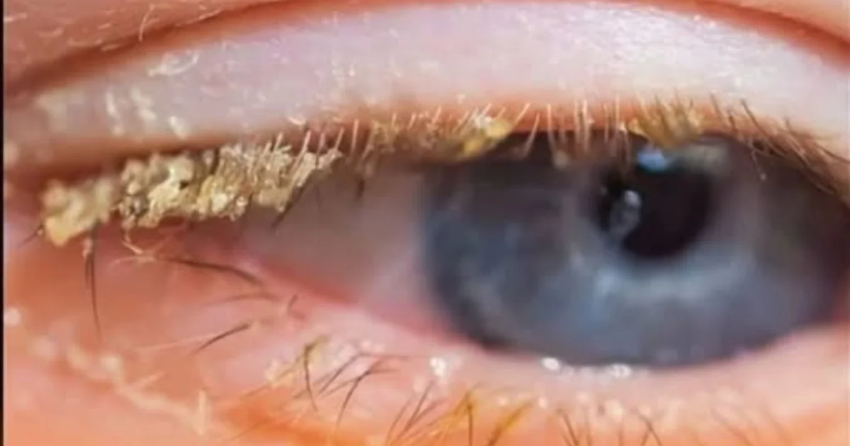 A crosta amarelada no canto dos olhos ao acordar pode ter uma explicação veja quando merece atenção