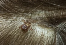 Carrapato no cabelo do seu filho: o que fazer e quais cuidados tomar