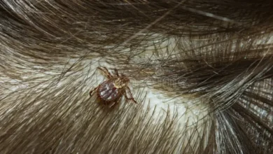 Carrapato no cabelo do seu filho: o que fazer e quais cuidados tomar