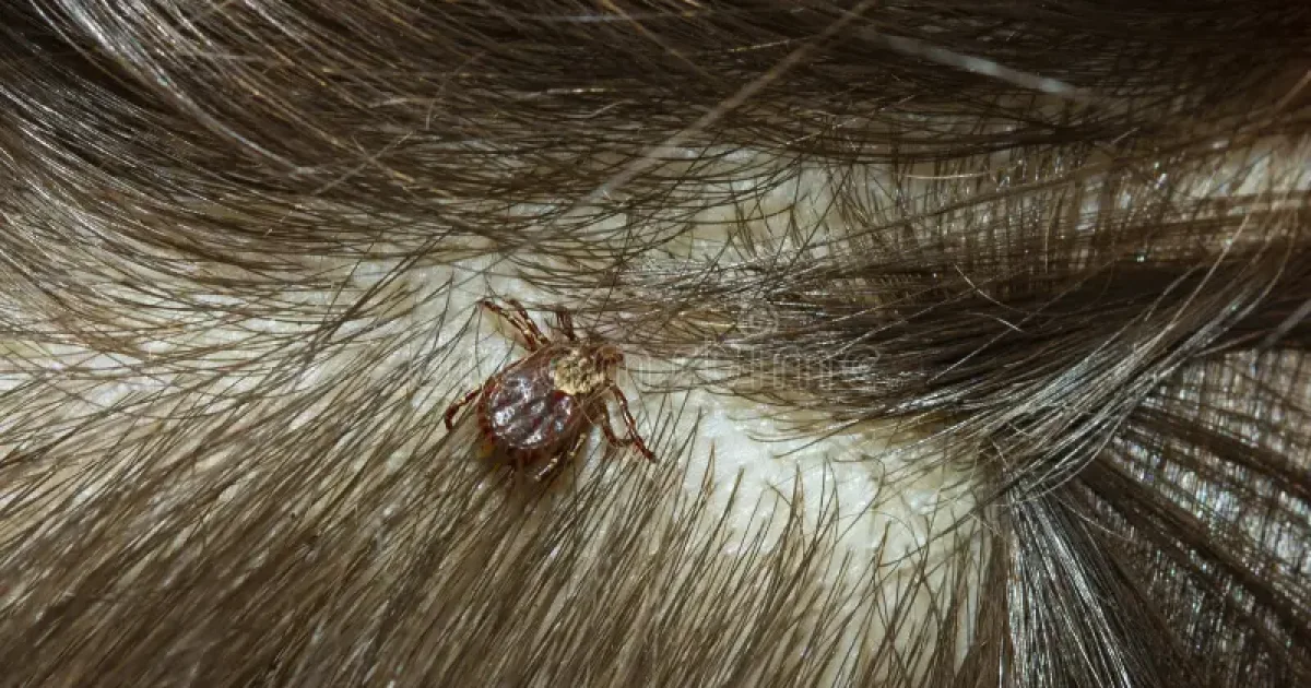 Carrapato no cabelo do seu filho: o que fazer e quais cuidados tomar