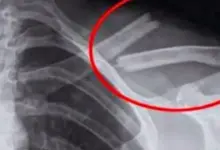 Esta bebida pode enfraquecer os ossos? O que a ciência realmente diz sobre o alerta que circula na internet