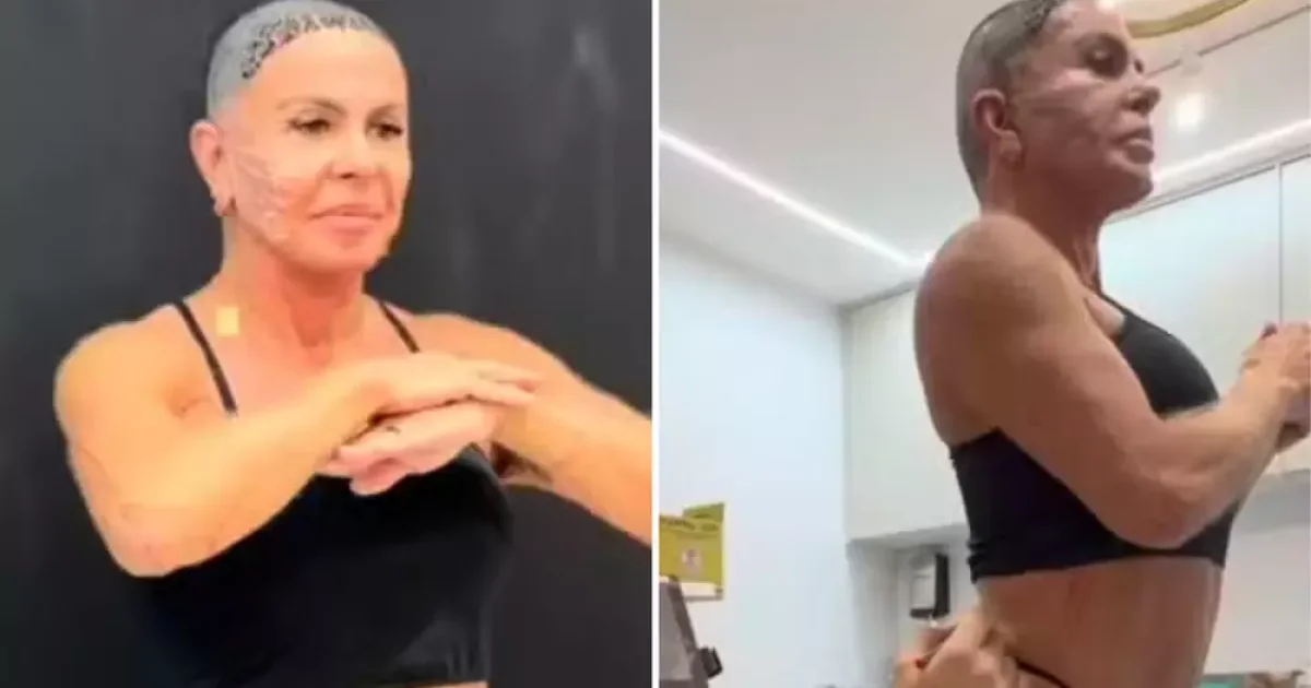Gretchen mostra novo visual após procedimentos estéticos e transplante capilar