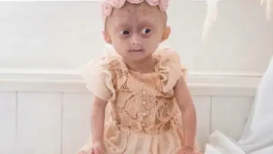 Morre Elis, uma das gêmeas de Roraima diagnosticadas com rara síndrome do envelhecimento precoce