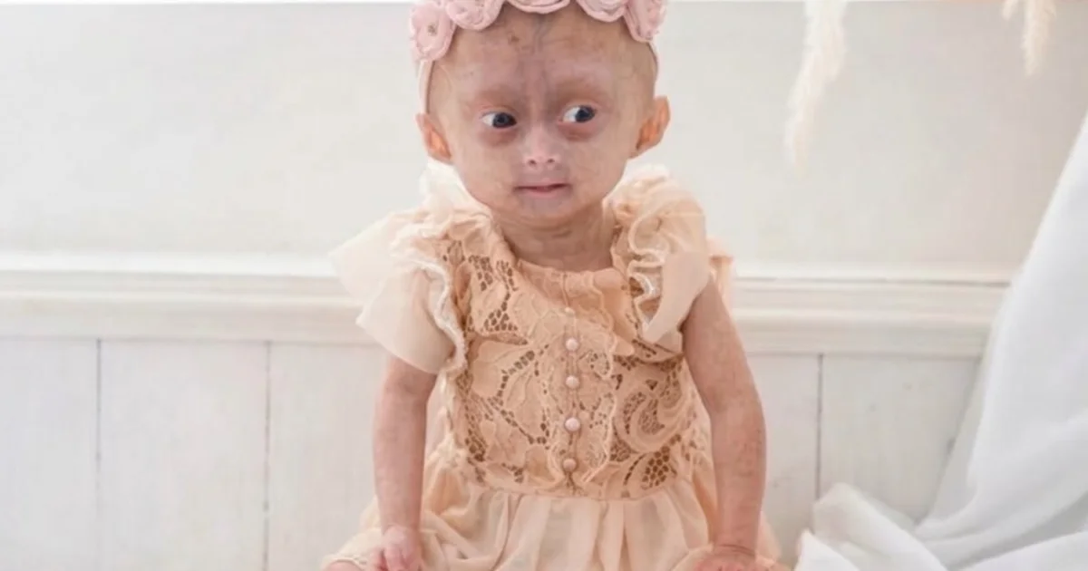 Morre Elis, uma das gêmeas de Roraima diagnosticadas com rara síndrome do envelhecimento precoce