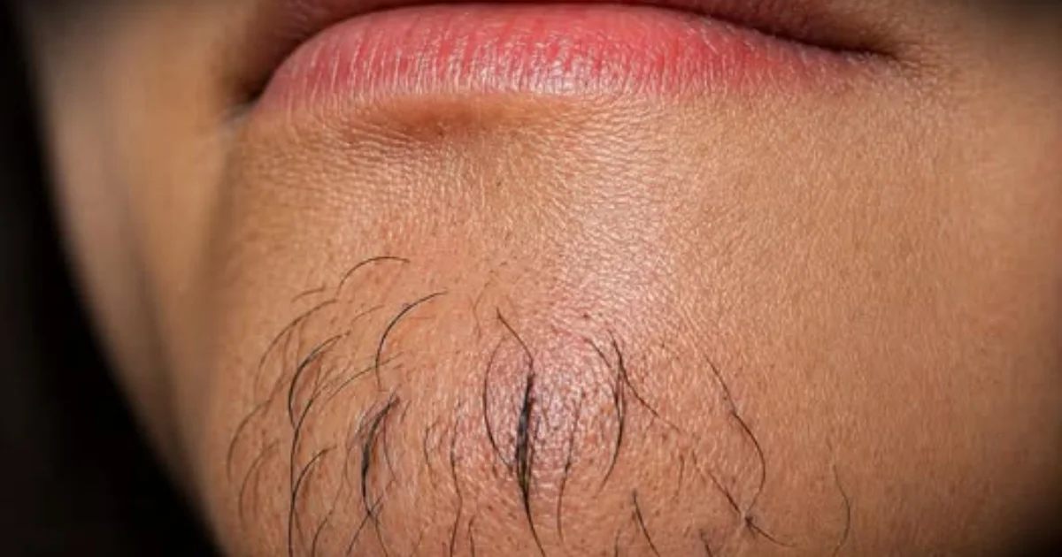 Pelo no queixo em mulheres: o que pode estar por trás desse sinal?