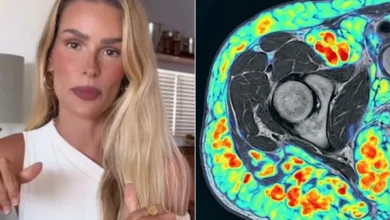 Susto na saúde: Yasmin Brunet desabafa sobre sintomas severos de doença sem cura