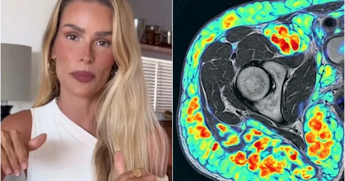 Susto na saúde: Yasmin Brunet desabafa sobre sintomas severos de doença sem cura