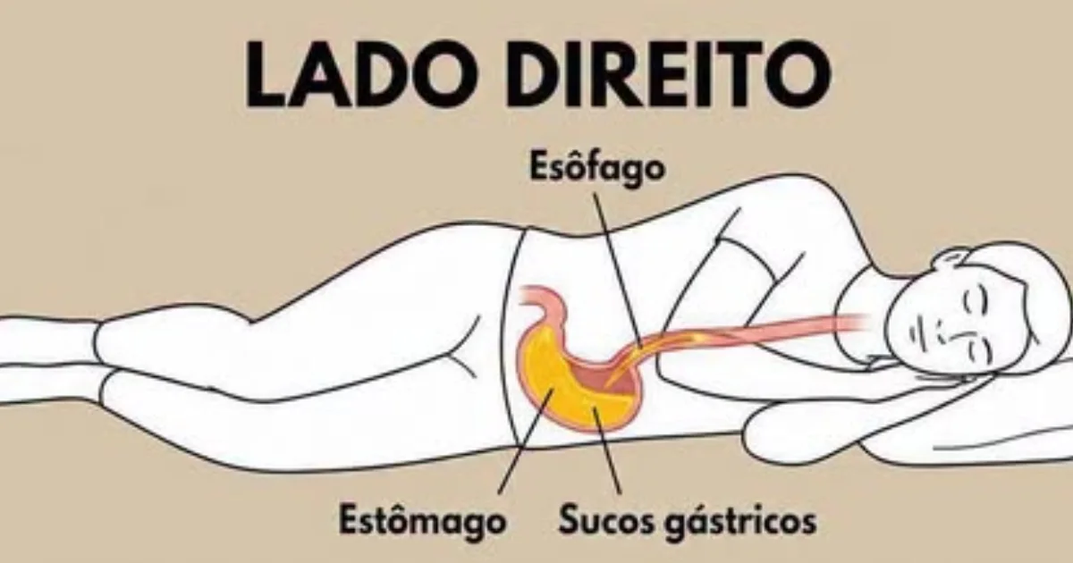 Dormir do lado direito pode piorar o refluxo? Entenda o que acontece com o estômago durante o sono