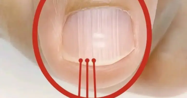 Linhas nas unhas depois dos 40 anos: quando são normais e quando merecem atenção